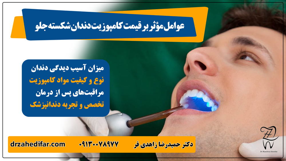 جدول مقایسه‌ای بین لمینت و کامپوزیت دندان